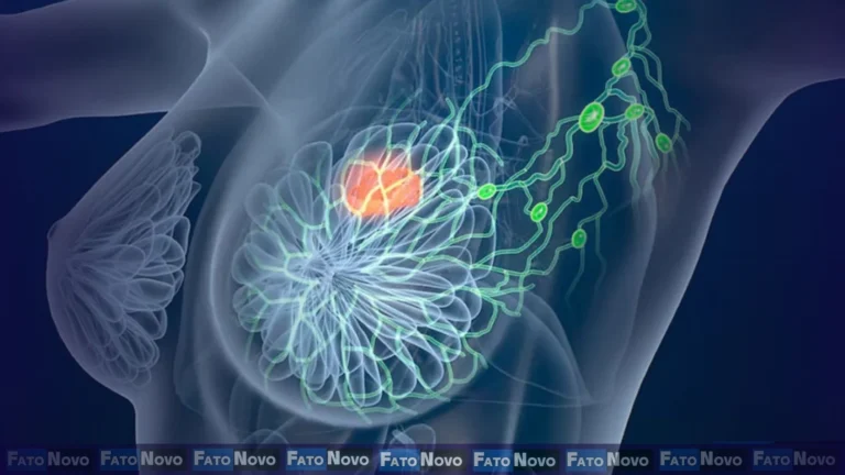 Câncer de mama RH-positivo: Nova combinação de drogas retarda progressão em 62% em pacientes com mutação no gene ESR1