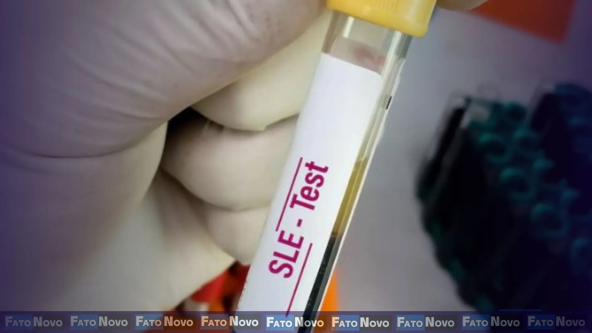 Roche apresenta resultados positivos de Fase III com obinutuzumab para Lúpus Eritematoso Sistêmico